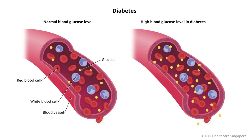 Diabetes Tipe 2: Strategi Pengendalian Gula Darah dan Pencegahan Komplikasi